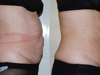 Inch Loss Before and After 03