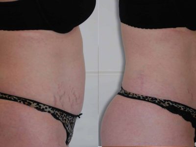 Inch Loss Before and After 08
