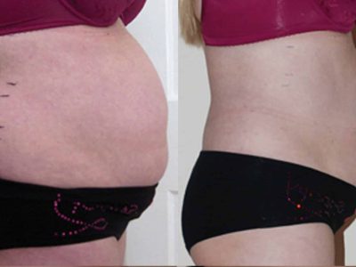 Inch Loss Before and After 10