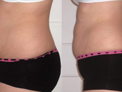 Inch Loss Before and After 17